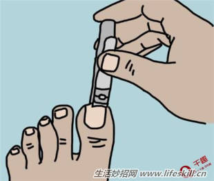 脚趾甲嵌进肉里，怎么办？