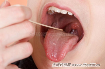 天天刷牙口中还有腐臭味，可能是你患扁桃腺结石了！
