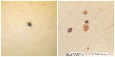 皮肤上出现黑点，千万别大意！可能会带来致命的危险！